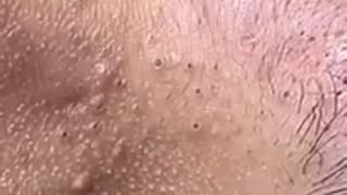 Y2Mate.is - Pimple Popping Blackheads-Fc4SCmBktKI-240p-1655002352612