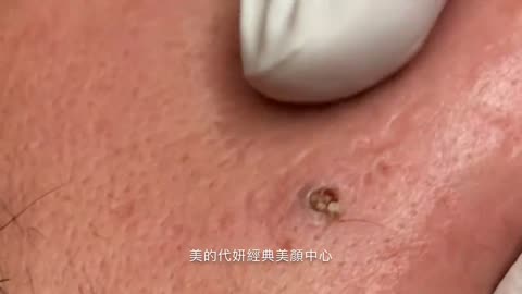 New blackhead removal