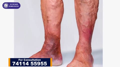 Homeopathic Medicine & Treatments for Varicose Veins