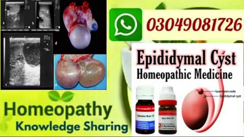 Male Infertility | epididymal cyst | cause, symptoms | Homeopatic medicine for epididymal cyst ??