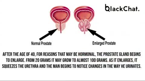 PROSTATE CANCER