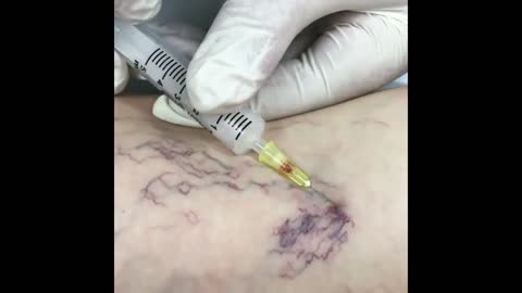 Spider veins (telangiectasias) being completely faded