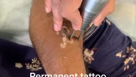 Experience Pain-Free and Safe Permanent Tattoo Removal with No Downtime