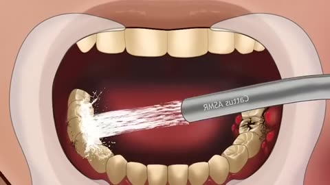 ASMR Treatment of Severe Tooth Decay