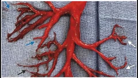 Masywne Biostruktury Skrzepów Krwi W Ciałach Zmarłych/ "Wysyp Nagłych Zgonów"