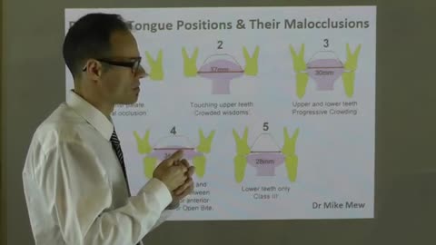 Effect of Tongue Positions on Teeth Alignment, Dental Arch, Lip Shape & Face by Dr Mike Mew