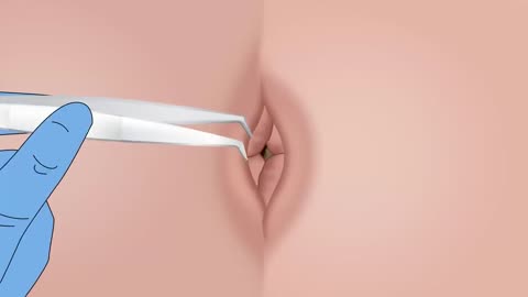 ASMR Remove Huge Navel Stone Animation - 거대한 배꼽 돌 제거 애니메이션