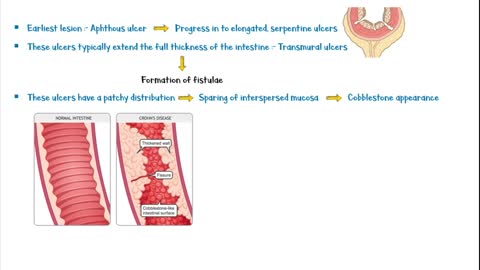 Crohn's Disease _ Causes, Pathogenesis, Clinical Presentation, Diagnosis & Treatment
