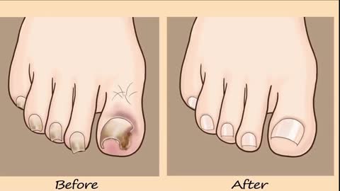 ASMR igrown Toenail removal treatment animation