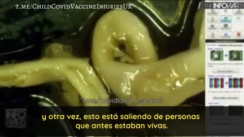 coagulos fibrosos en venas de vacunados covid fallecidos