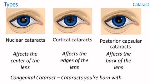 What is Cataract? | Its Symptoms, Treatment and Surgery