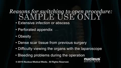 Laparoscopic Appendectomy Surgery