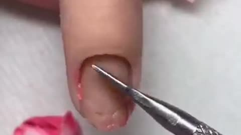 My client got something stuck in her finger ?