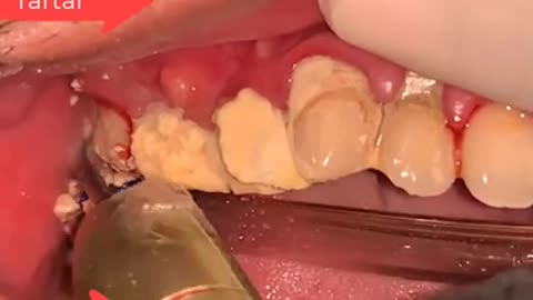 Tartar Dentist | Dentalwork 2021
