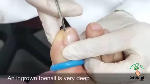 DEEP INGROWN toenail REMOVAL (CLOSE UP)
