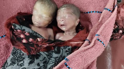 Extremely preterm (non-viability period) Twin babies born at 23 weeks of pregnancy