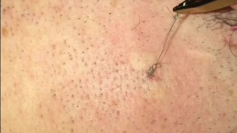 Blackheads