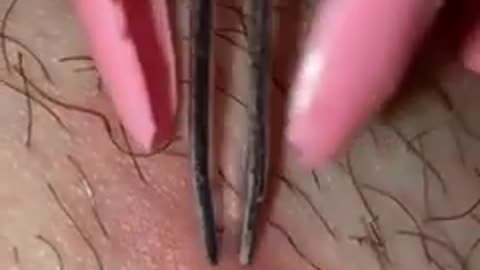 eye treatment animation eye pimple Acne Removal