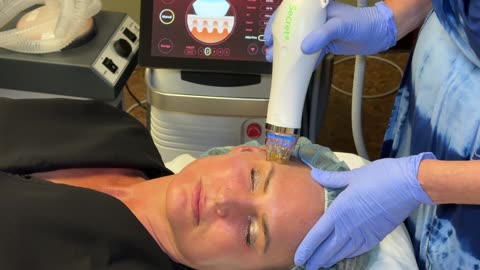 Secret Pro RF Micro Needling