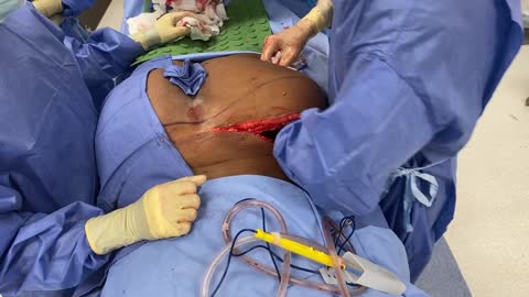 Incision for Removal of Illegal Buttock Silicone Injections | Plastic Surgery Procedure