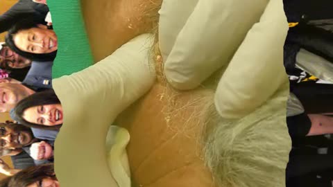 Pimple popping and blackhead