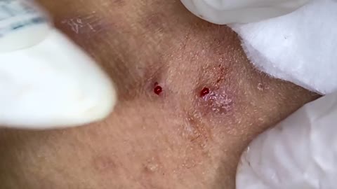 Big Cystic Acne Blackheads Extraction Blackheads & Milia, Whiteheads Removal Pimple Popping