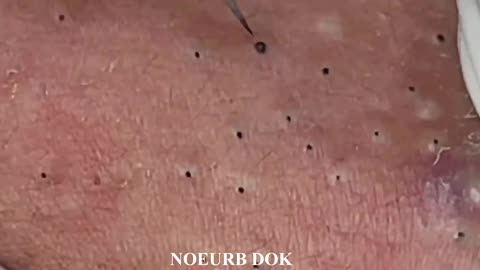Ultimate Blackhead Extractions: A Popping Compilation