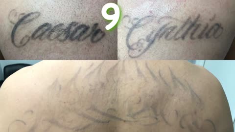Lazer Tattoo Removal - 15 Sessions Later
