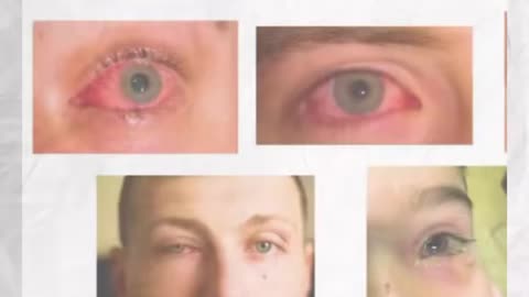 eye infection. causes and precations