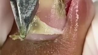 Painful Toenail ingrown removal #1