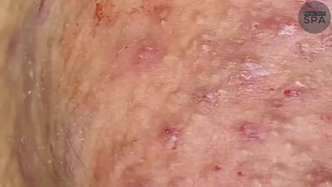 Relaxing SPA Pimple Popping videos l Relax Every Day With SPA l EP 01