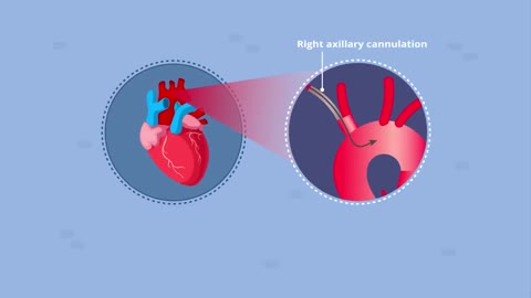 Evolution of right axillary artery cannulation technique cannula to graft to artery || Dr Calcaterra