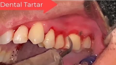 Tartar Dentist 2021 | Satisfying Dental-work