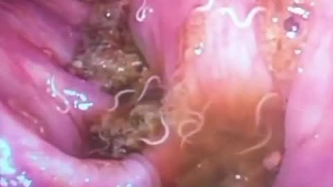 Ward Dean MD | Endocopic picture of a huge number of pinworms in the large intestine