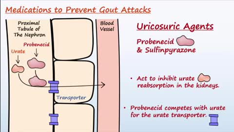 Chronic Gout Treatment - The Second Phase of Treating Gout -6 of 6-