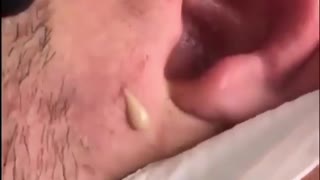 Cyst Popping out from a man's ear