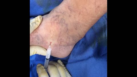 Varicose and Spider Vein Treatment with Schlerotherapy by Dr Garcia