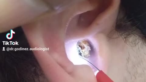 Satisfying Earwax Removal