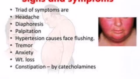 Cushing's syndrome