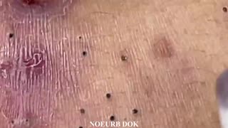 Popping Tons of Blackheads Part 2