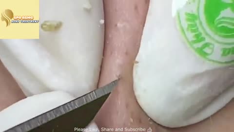 Big Blackhead removal