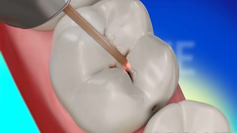 Waterlase Laser Dentistry for Dental Restoration - BIOLASE