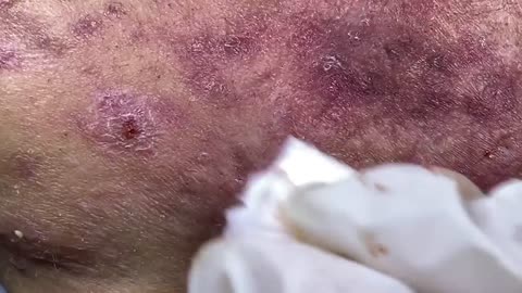 Acne cysts blackhead extraction