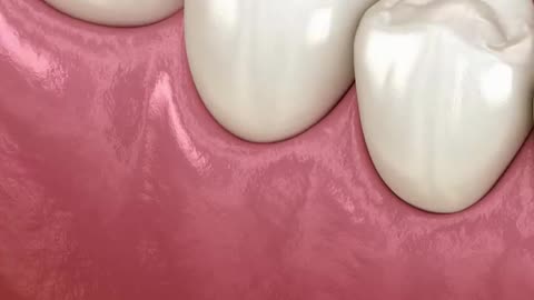 Dental Restoration Procedure
