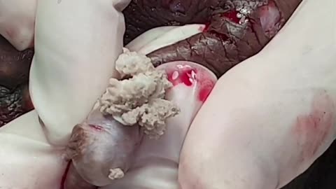 Scrotal Cyst Popping