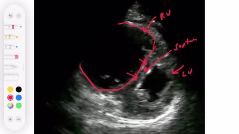 Ultrasound cardiac RV strain