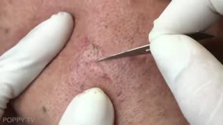 Deep Blackheads Removal from Cheeks and Nose Best Pimple Popping Videos