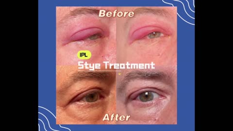 stye treatment by IPL, before and after compilation video