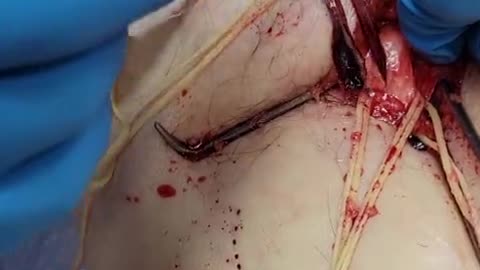 Unbelievable blood clots: video from embalmer Richard Hirschman