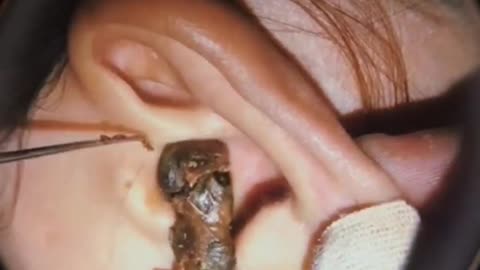 Earwax removal